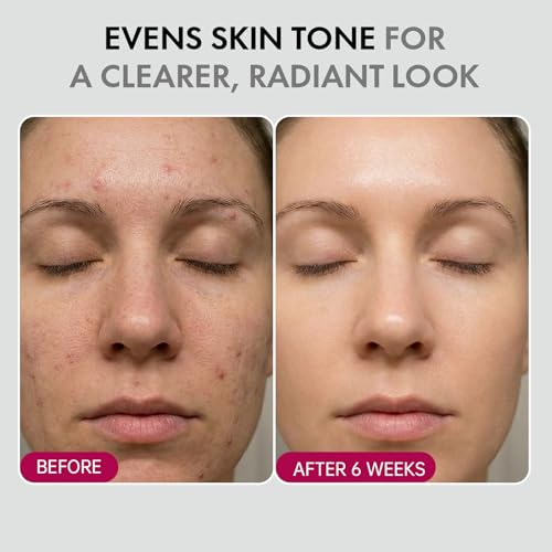 Glopink 2Pcs Arbutin 7% + Tranexamic Acid 4% Cream, 70,000ppm Arbutin & 40,000ppm TXA, Niacinamide Formula, Helps Reduce the Look of Dark Spots for a More Even, Radiant Tone, Hydrating Facial Moisturizer