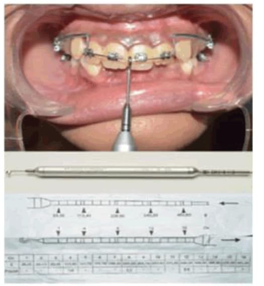 Miniatura 6 de Sino Dental Orthodontic Brackets Dontrix Force Gauge Dynamometro, marca grabada en negro, mide hasta 14.11 oz, hecho de acero inoxidable