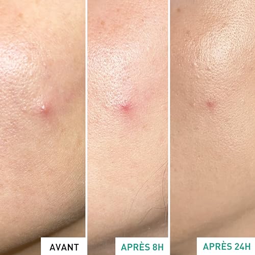 Erborian Centella Sos Patch Trattamento Localizzato Contro Le Imperfezioni Della Pelle Acneica 9 Ml - 6