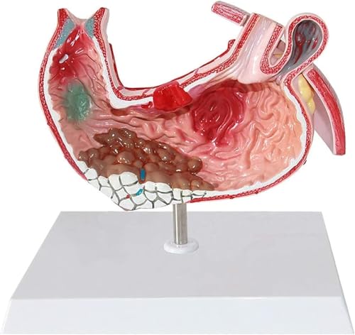 Modèles médicaux d'ulcère gastrique pour simplifier les diagnostics - 6