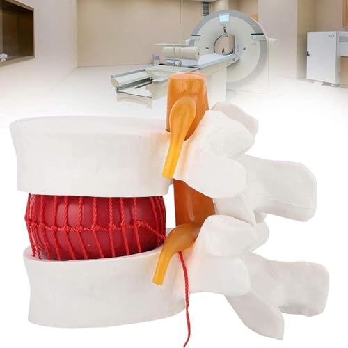 Modèle de hernie discale lombaire pour illustrer la compression