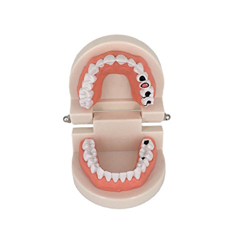 Decay Tooth Model, YOUYA Dental Caries Standard Teeth Teaching Model Study Tool Adult Disease Standard Typodont Demonstration Teeth Model for Kids Oral Care Teaching