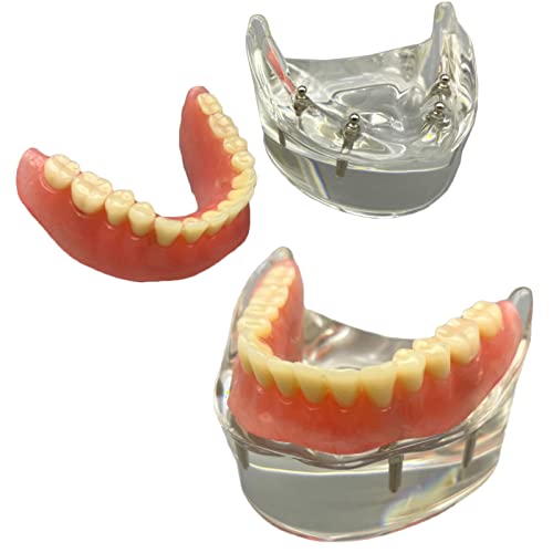 Dental Implant Model – Transparent Overdenture Demo for Study Dental Implant Model – Transparent Overdenture Demo for Study