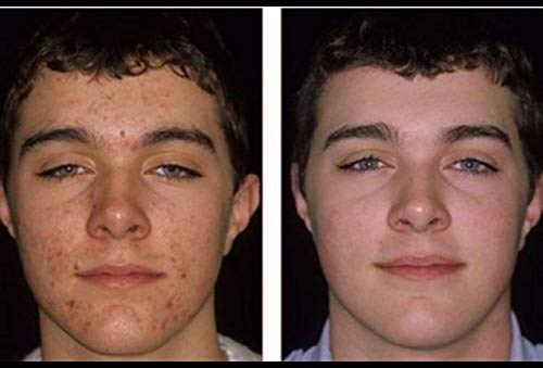 Acnetame Acne Pills- Vitamin Supplements For Acne Treatment- Natural Clear Skin From Hormonal Cystic Pimples- Oily Skin Vitamins Pill For Women, Teen, Men, & Adults 60 Tablets #TOP2