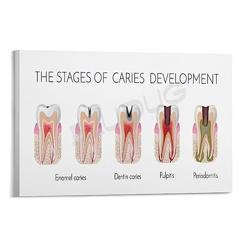 BLUDUG Dental Infographic Poster Posters of The Stages of Caries Formation Canvas Painting Wall Art Poster for Bedroom Living Room Decor16x24inch(40x60cm)