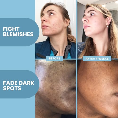 Image of Vitamin C Serum for Face with Retinol & Salicylic Acid - Skin Clearing Acne Spot Treatment with Niacinamide, Hyaluronic Acid, MSM - Anti-Aging Facial Serum for Dark Spots and Blemishes