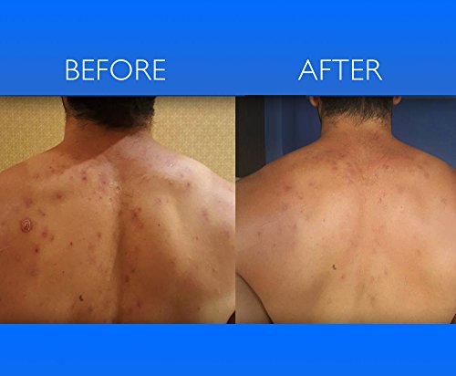 Non-Comedogenic Hair Conditioner For Blemish Free Skin By Clear 2 Perfection With Fresh Cells Strawberry And Kiwi Suspensions. Hair Conditioner For Acne. Made In Usa #TOP6