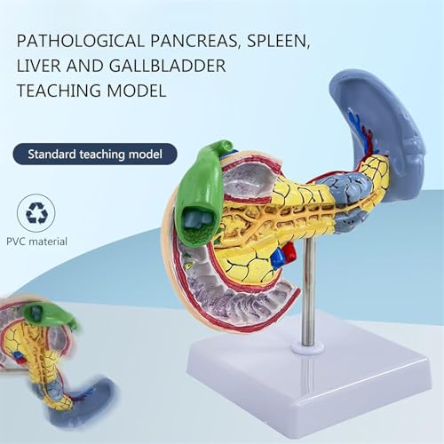Pancréas pathologique AMITD modèle anatomique avec duodénum pour démonstration médicale - 3