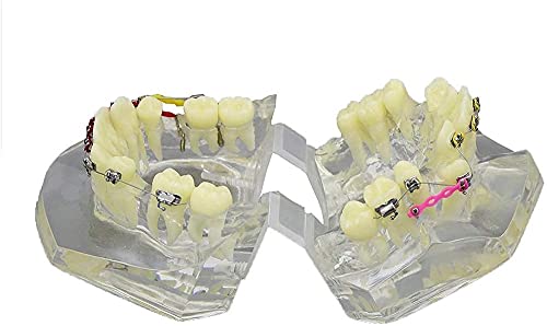 Modèle dentaire malocclusion et traitement orthodontique d'étude avec crochets - 8