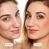 Acne Treatment,12% Acid Spot Cream for Spot Prone Skin,Anti Acne,Rosacea Cream for Face,Dark Spo-t Remover,Pimple Crea-m,Face Moisturiser for Blemish Control,Blackhead Remover,Even Skin Tone (1PCS) - Image 5