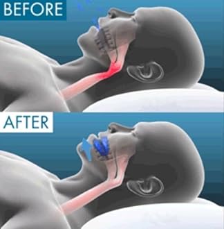 Anti Snoring Mouthpiece, Anti-Snoring Mouthpiece Universal Size, Comfortable Anti Snore Mouth Guard, Anti Snoring Devices 4.0, Instantly Eliminates Snoring Enjoy Sleep (2)