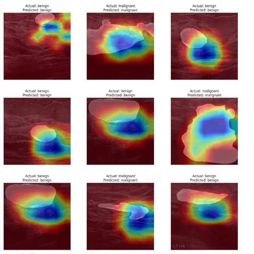 Page de couverture de How AI is Revolutionizing Breast Ultrasound Diagnostics with EfficientNet-B7 and Explainable Insights
