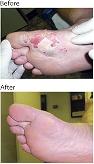 Wound Honey, Manuka Honey Wound Cream with Active Manuka Honey