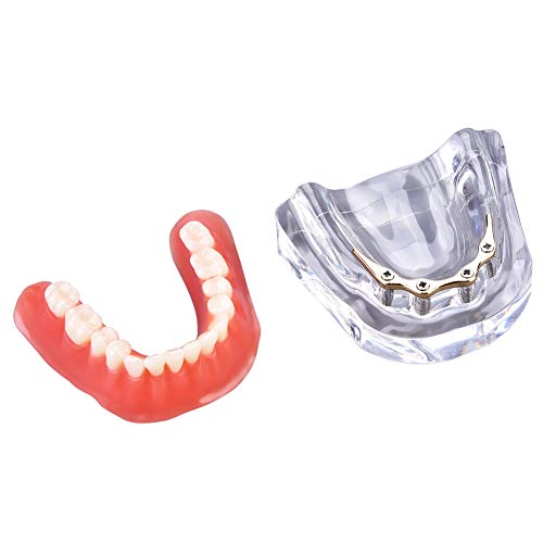 Dental model - tandtanden studiemodel deck prothesentanden minderwaardige precisie implantaat voor de leermonstratie… - Image 3