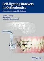 Algopix Similar Product 16 - Selfligating Brackets in Orthodontics