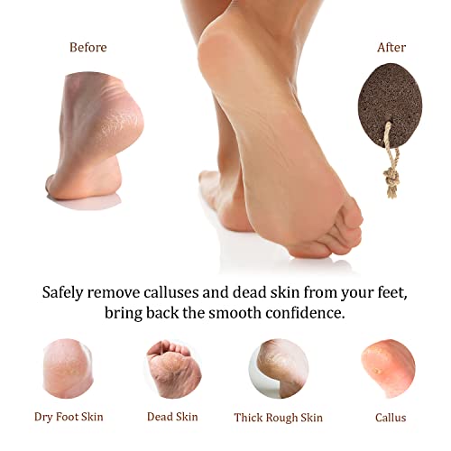 Pumice Stone For Feet Callus Remover - Earth Lava Foot Pumice Stone For Callous Warts Dead Skin Removal - Natural Exfoliating Stone Foot Scrubber For Dry Cracked Heels & Hands For Use In Shower #TOP3