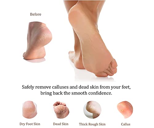 Foot File Callus Remover for Feet - Double Sided Emery Board - Effortless Dead Skin Removal - As Supplied by NHS Podiatrists - Image 8