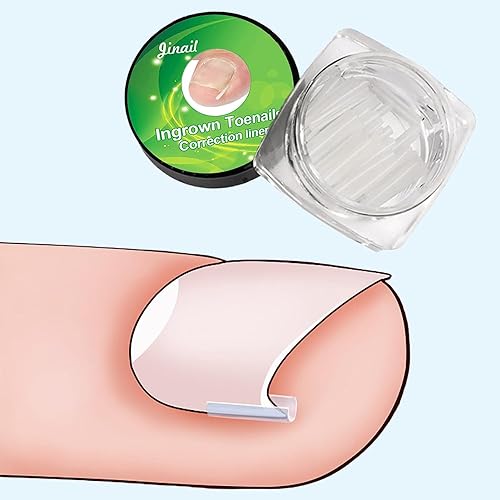 10 Pcs Ingrown Toenail Correction Strips Brace Kit, Ingrown Toenail Corrector Straightener Strips Recover Clips Toenails Thick Pedicure Tool Toenail Straightener Strip for Men Women Foot Care Tool Gr - Thumbnail 3