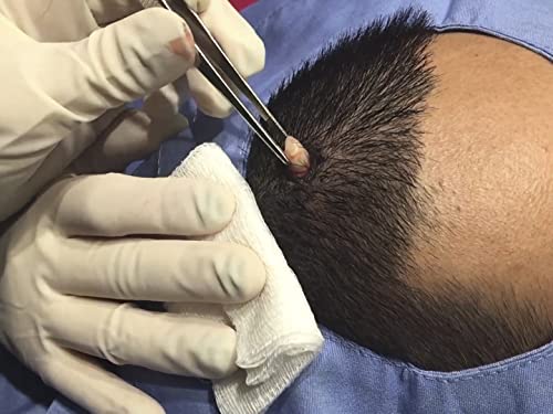 A Pilar Cyst and a Blackhead