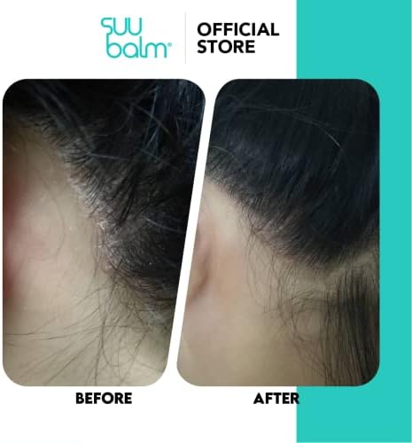 Suu Balm Scalp Spray - Rapid Itch Relief Scalp Moisturiser - Itch Relief in 5 Minutes - Dry, Flaky, Itchy Scalp Treatment (100ml)