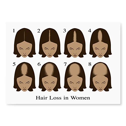 Posterazzi Hair Loss Poster Print by Gwen Shockey/Science Source, (24 x 18), Varies