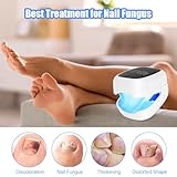 AOOWU Nail Fungus Laser Device with Time Display, Portable Fungal Nail Treatment for Toenails Extra Strong, 7-Minute Toenail Fungus Treatment, 940nm Infrared Light 500nm Blue Light, Safer Painless - Image 8