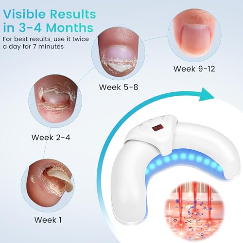 Nail Fungus Laser Device, Nail Light with 910nm Infrared Light and 470nm Blue Light, Nail Fungus Treatment for Toenail & Fingernails, Portable Nail Fungus Cleaning Device, Safe & Reliable - 3