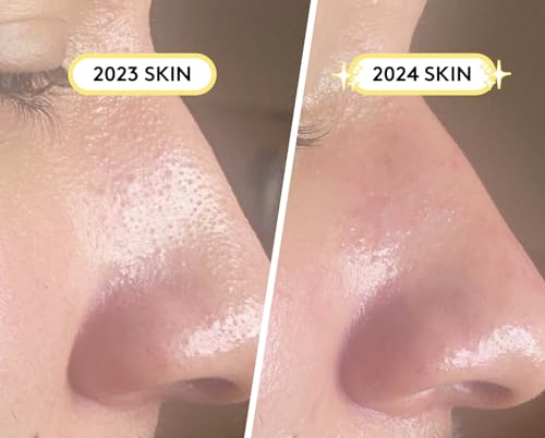 SKIN CHOICE Pore Strips - Breakout Patch XL Hydrokolloid Mitesserentferner Stripes to Unclog & Shrink Pores, Absorbiert Öl, Mitesser Nase Entfernen, For Pickel und Akne, Vegan (10 Stück)