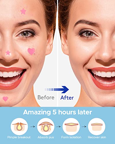 LitBear Adesivo para Acne, Adesivo para Espinhas, Coração Rosa e Adesivo Absorvente Em Forma de Estr