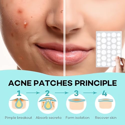 TIKIYOUN Adesivos de espinhas para acne hidrocolóide facial para cobrir espinhas e manchas, 2 tamanh