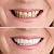 ZNXY 4 Pairs Top and Bottom Denture Fake Teeth Veneer Dental,Veneers Snap in Teeth,Cosmetic Tooth Replacement Kit for Real Teeth, Top Only One Size Fits Most