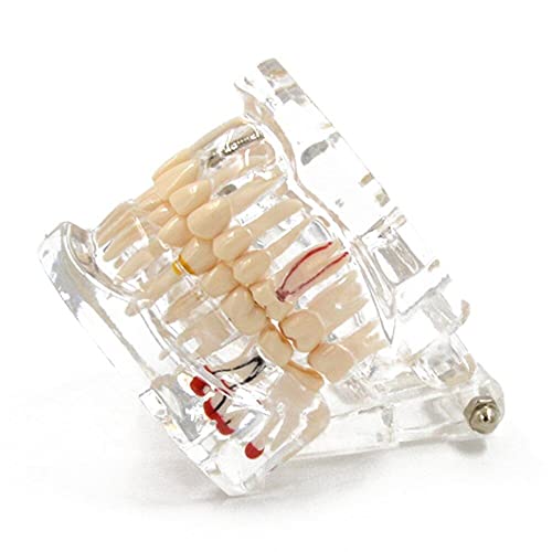 Modèle dentaire de restauration Hrippy pour comprendre l'implant