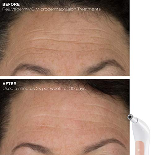 Trophy Skin Rejuvadermmd - Microdermabrasion Machine On-The-Go - Facial Exfoliation With Real Diamond Tip For Radiant And Youthful Skin #TOP5