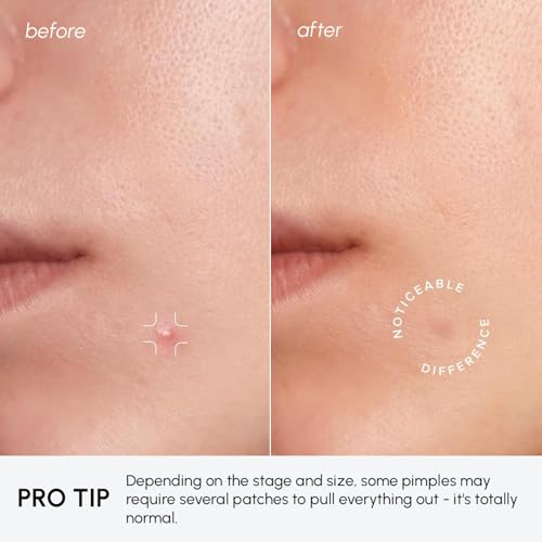 Image of MAREE Invisible Pimple Patches - Clear Pimple Patches for Face - Hydrocolloid Acne Patches Anti Blemish - Zit Stickers for Face - Parches Para Acne - Pinple Zit Patches Pimple Stickers - 72 Dots
