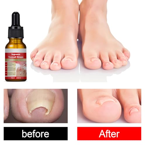Eingewachsene Zehennägel Behandlung - 30ml Eingewachsene Zehennägel - Nagelhautpflege Öle für eingewachsene Zehennägel