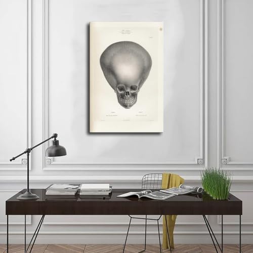 Impression sur toile crâne d'hydrocéphalie Joseph Vimont 50x75 cm - 3