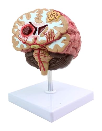 Modelo anatómico de hemorragia cerebral del tronco encefálico y patologías formativas 4