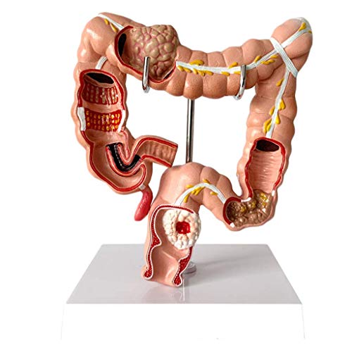 Anatomy Human  Visceral Colon Rectum Pathology Intestine Medical Anatomical Model