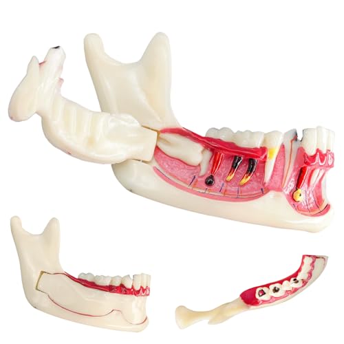MediTrainer Dental Mandibular Decomposition Tooth Model
