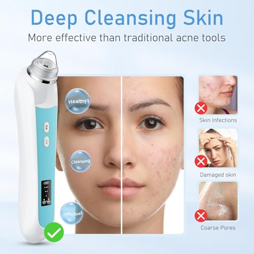 Image of Facial Pore Blackhead Remover Vacuum, 1080P Camera Blackhead Remover, 20x Zoom, 8 LEDs & 3 Suction Modes, 800mAh Battery & USB - 6 Heads Pore Cleaner Kit for Women&Men(Blue)
