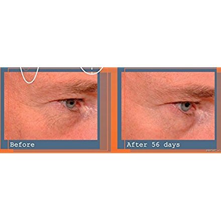 Babyface Argirelina e matrixyl 3000 CONCENTRATO