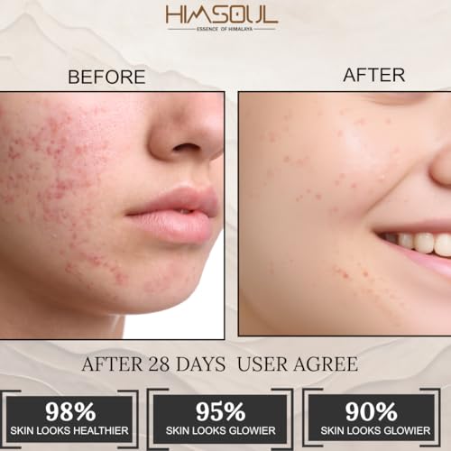 Image of Teen Anti-Acne Cream | Ideal for Ages 13 to 19 (Teen) | Natural Lightweight Moisturizer with Tea Tree Oil Neem Niacinamide & Himalayan Seabuckthorn | BHA-Based Acne Treatment | Soothes Hydrates & Clears Breakouts | Paraben-Free Sulfate-Free Vegan | 50 g