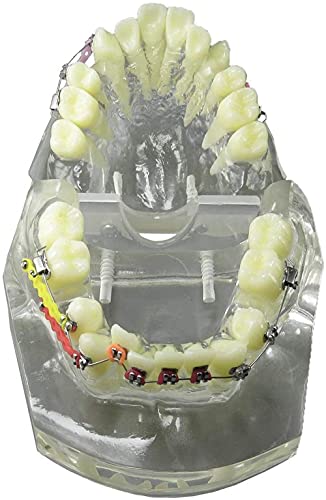 Modèle dentaire malocclusion pour expliquer le traitement aux patients