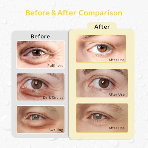 Image of 4PCS Gel Eye Ice Pack Set, Cold & Hot Compress, Reusable Cooling Gel Pads for Strain Relief, Swelling, Dark Circles, Redness, Puffy Eyes, Surgery Recovery(4 Yellow flowers)