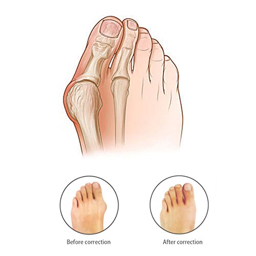 Tinksky - Separatore per dita dei piedi, in