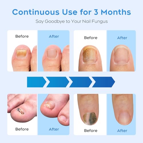 Nail-Fungus-Light-Device-for-Multiple-Toenails-fingernails-Nail-Repair-Solution-for-Damaged-and-Discolored-Nails-Suitable-for-Home-Use-White