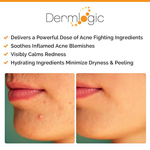 Acne Spot Treatment- Overnight Treatment For Whitehead & Blackhead Pimples. Eliminate Cystic Breakouts & Clogged Pores. Clears Away Severe, Mild, Moderate Blemishes For Teens & Adults. Alcohol-Free. #TOP2