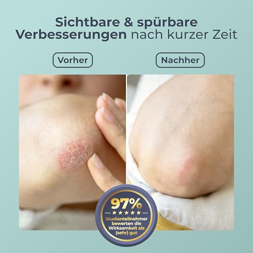ectocare® Psoriasis Creme Akut mit 5% Ectoin 30ml | Schuppenflechte Salbe ohne Kortison | Medizinprodukt...