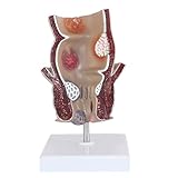 Anatomisches Modell der rektalen Hämorrhoidenpathologie: Detailliertes Modell des Kolorektums mit Darstellung von Hämorrhoiden, Fisteln, Fissuren und Abszessen Anatomische
