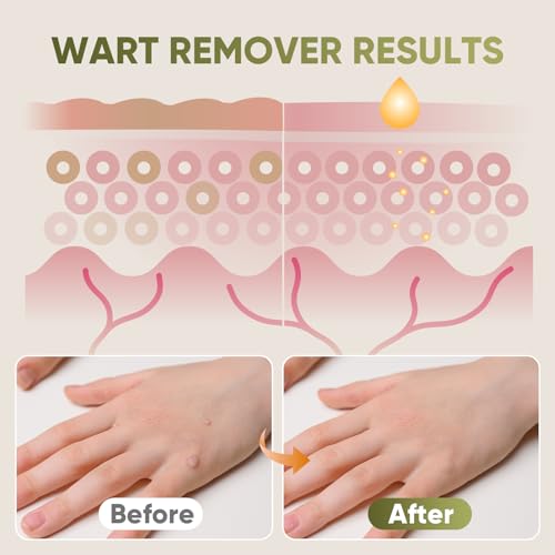 Image of inchSTAY STOKED inch Wart Remover, 15ml Salicylic Acid Wart Remover - Gentle Yet Powerful for Plantar Warts, Flat Warts & Calluses, Safe for Daily Use on Hands, Feet & Skin-H5515